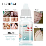 Kills 99.9% Bacteria Nail Fungus Treatment